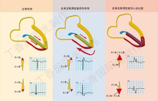 双侧束支传导阻滞 快懂百科