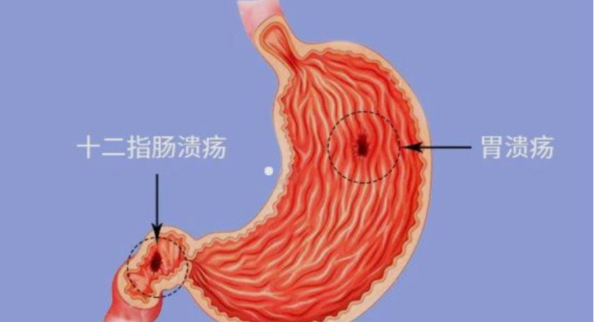 十二指肠溃疡 快懂百科
