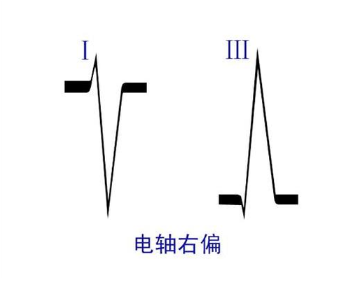 心电轴右偏 右室肥大及右束支传导阻滞在心电图上的表现 头条百科