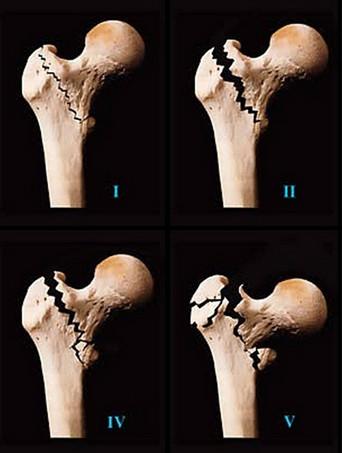 粉碎性骨折 快懂百科
