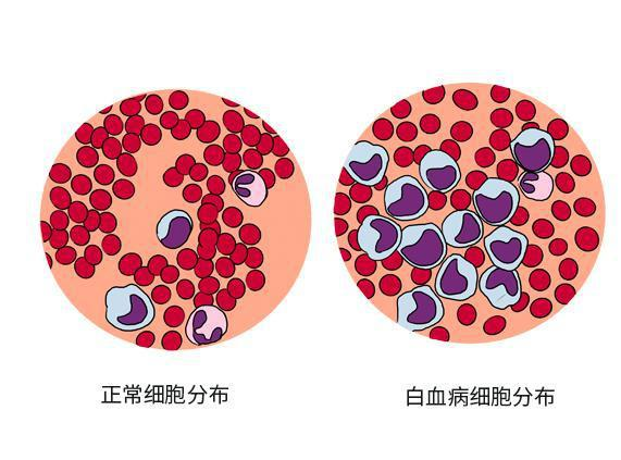 早期白血病 快懂百科