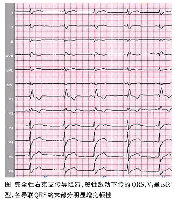 完全性右束支传导阻滞 快懂百科