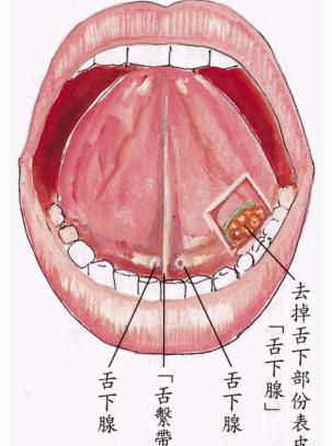 舌下腺囊肿 快懂百科