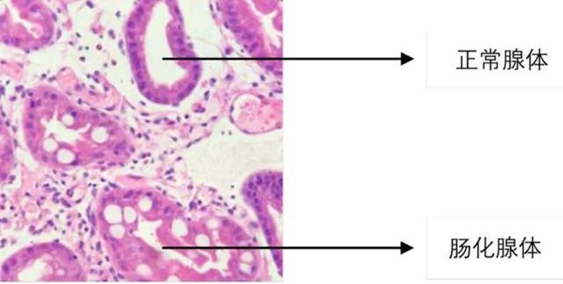 肠上皮化生 快懂百科