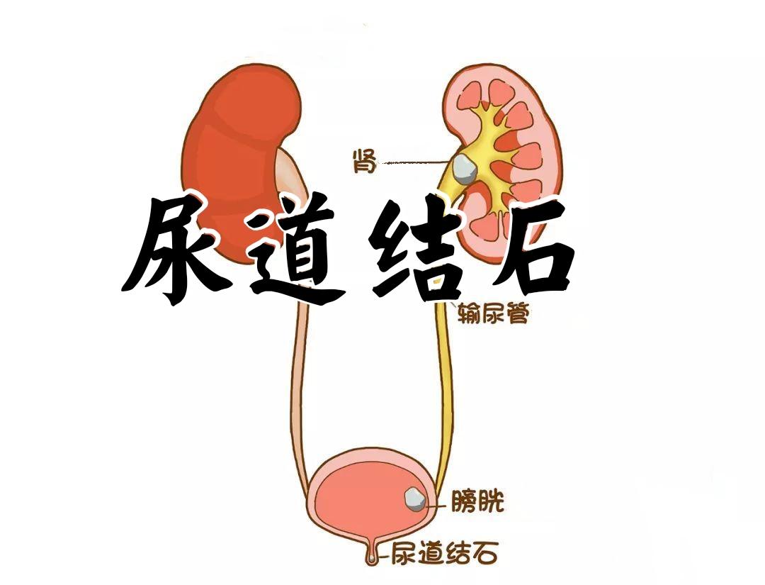 长期留置尿管的患者管理_澎湃号·湃客_澎湃新闻-The Paper