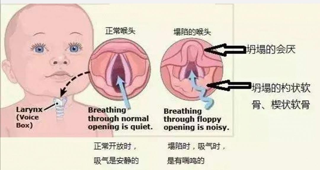 喉喘鸣